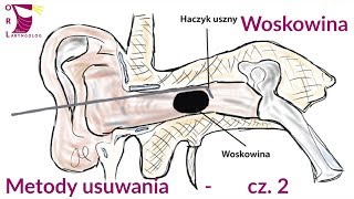 Metody usuwania woskowiny  cz2  praktyczna [upl. by Eirelav]