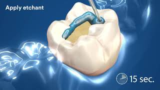 How to Use 3M Single Bond Dentbearcom [upl. by Patrick643]