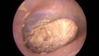 A Compilation of Foreign Body Removals amp Extractions from the Ear Canal by The Wax Whisperer  333 [upl. by Akoyin534]