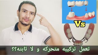 تعمل تركيبه متحركه و لا تركيبه ثابته لاسنانك افضل [upl. by Evaleen]