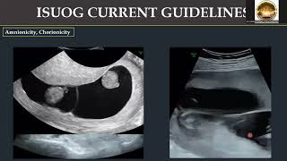 Applying Updated 2023 ISUOG Practice Guidelines in 11 14 Weeks Scan Part 1 By DrRaghavendra [upl. by Avie]