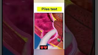 piles problem treatment 3d animation।।shorts piles treatment viralshorts [upl. by Brent8]