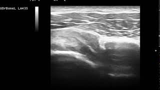 洪辰宇醫師 肩關節喙突下夾擠症候群 超音波動態檢查  Subcoracoid impingement dynamic US examination [upl. by Doug]