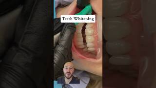 Inoffice teeth whitening cosmeticdentist teethwhitening [upl. by Anemaj]