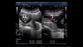 Anencephaly with a pregnancy of about 17 weeks 02 days [upl. by Gerson127]