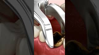 Tooth Extraction In Shreveport  toothextraction Shreveport [upl. by Nayt]