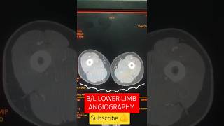 BL LOWER LIMB ANGIO youtubeshorts viralshorts hemantkushwah3453 [upl. by Brownson321]