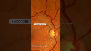 Hypertensive retinopathy [upl. by Meehar]