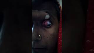 recorrent episcleritis from 2 years youtubeshorts shortvideo episcleritis eyedoctor doctor [upl. by Amees]