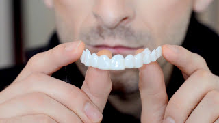 I Tried TruSmile Veneers and this is what happened [upl. by Hodosh]