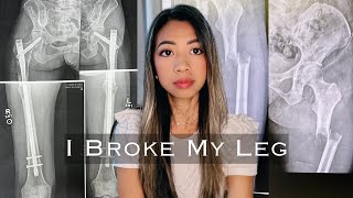 My 1 Year Recovery from Bilateral Femur Fixation Surgeries  Living with Stage 4 Cancer [upl. by Yremrej]