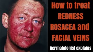 How to treat rosacea redness amp facial veins [upl. by Artinad]