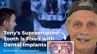 Tonys Supraerupted Tooth Fixed With Dental Implants [upl. by Oloapnaig244]