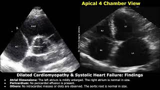 Dilated Cardiomyopathy amp Systolic Heart Failure Echocardiography Report Example  Cardiac Diseases [upl. by Moberg]