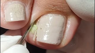 A ESPÍCULA QUERIA SAIR DE QUALQUER JEITO INGROWN TOENAILS nails manicure unhaencravada [upl. by Eyahc311]