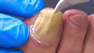 Trimming a THICK FUNGAL TOENAIL under SUPER ZOOM [upl. by Nyrraf598]