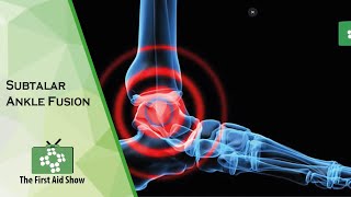 Subtalar Ankle Fusion [upl. by Hilton]