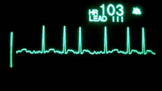 Atrial Fibrillation [upl. by Akemahc]