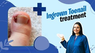 Ingrown Toenail Treatment  Ingrown Toenail Removal Procedure  Is Ingrown Toenail Surgery Painful [upl. by Yaker]