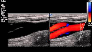 NORMAL CAROTID ARTERY COLOR COMPARE [upl. by Eelasor]