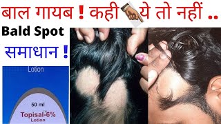 बालों का झड़ना रोकेTopisal6Lotion 100Resultbald spotHair Fall stopanil Sharma [upl. by Ayila]