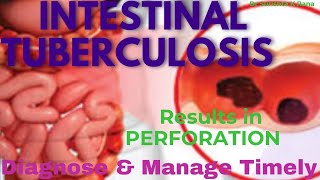 ILEOCOLIC RESECTION in INTESTINAL TUBERCULOSIS [upl. by Tillie]