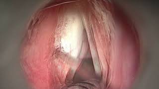 PHONOSURGERY  LEFT VOCAL FOLD PALSY [upl. by Adrahs88]