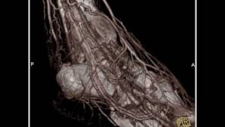 Vascular CT angiography of the lower extremity3 of 3 [upl. by Rus]