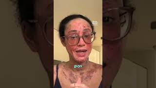 My Nightmare Skin Condition viralvideo birthdefect viralshort [upl. by Enyledam]