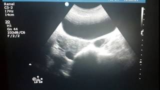 Para Ovarian Cyst [upl. by Esorylime58]