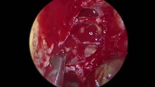 Full Functional Endoscopic Sinus Surgery FESS for sinusitis [upl. by Hatokad284]