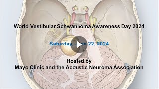 Cochlear implantation after treatment for vestibular schwannoma [upl. by Sherrod]