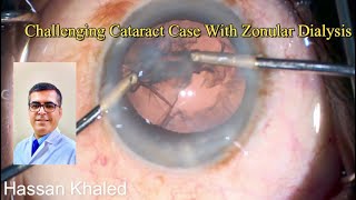 Challenging Cataract Case With Zonular Dialysis [upl. by Piefer]