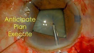 Manual SICS with Iris Retractors in an eye with Pseudoexfoliation ampLoose Zonules Dr Deepak Megur [upl. by O'Meara]