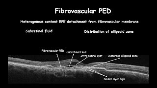 AgeRelated Macular Degeneration Current Treatments and Future Therapies [upl. by Akerdna939]