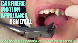 CARRIERE Motion Appliance REMOVAL  Tom Nasiopoulos [upl. by Vories]