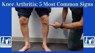 Knee Arthritis 5 Most Common Signs You Have It [upl. by Bradney718]