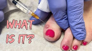 Rosie Toesies Mystery Toe Bump  Cyst or Not NEW [upl. by Ennazus]