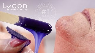 Goodbye Pesky Chin Hairs With LYCOJET Lavender Hot Wax  LYCON Cosmetics [upl. by Bloxberg70]