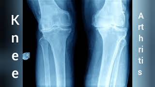 knee Arthritis X ray Both knee Arthritis show affect [upl. by Macdonell]