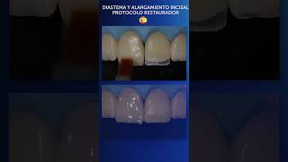 Diastema y Alargamiento Incisal carillasdirectas [upl. by Garrik470]