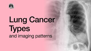 Lung Cancer Types [upl. by Elisabetta602]