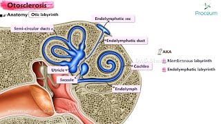 Otosclerosis 👂  ENT Lectures [upl. by Doris]