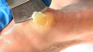 Callus removal from feetampFoot scraping dead skin【Xiao Yan pedicure】stress 615 [upl. by Suravaj589]