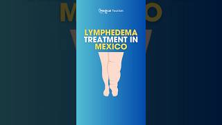 Get treatment for lymphedema in Mexico  Medical Tourism [upl. by Shanan]