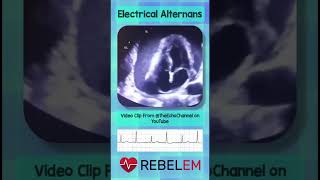 Electrical Alternans REBELEM ECG EKG PericardialEffusion ElectricalAlternans FOAMus MedEd [upl. by Keller678]