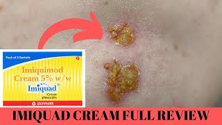 quotImiquad Cream Review Skin Wars and Wart Whispers 💪🌟 SkinSuperhero ImiquadUnveiledquot [upl. by Cida]