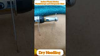 Electro dry needling treatment for neck pain acupuncture dryneedling physio asmr viralshorts [upl. by Pinckney974]