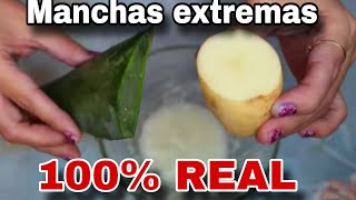 Como QUITAR MANCHAS de tu cara EXTREMAS melasma Remedio Casero [upl. by Sadoc261]