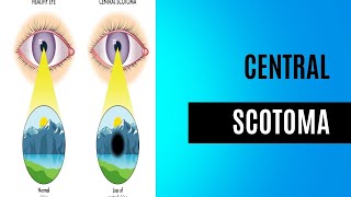 Central Scotoma  Visual Field Disorder [upl. by Esbensen68]